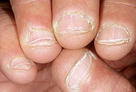 Шелушение кожи вокруг ногтей из-за сухости кожи