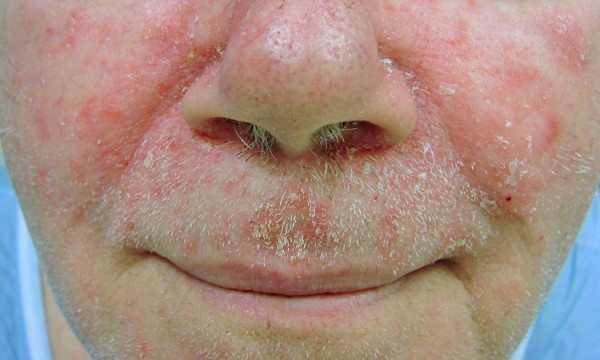 Себорейный дерматит вокруг рта и носа