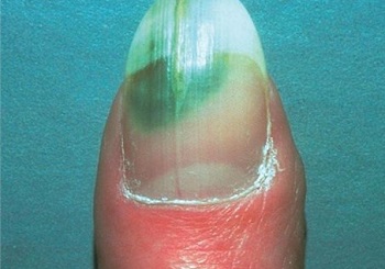 Темно-зеленое пятно на ногте из-за бактериальной инфекции