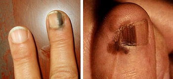 Акральная лентигинозная меланома ногтя