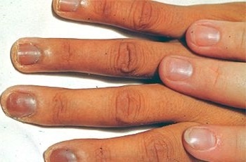 Потемневшие ногти при болезни Аддисона