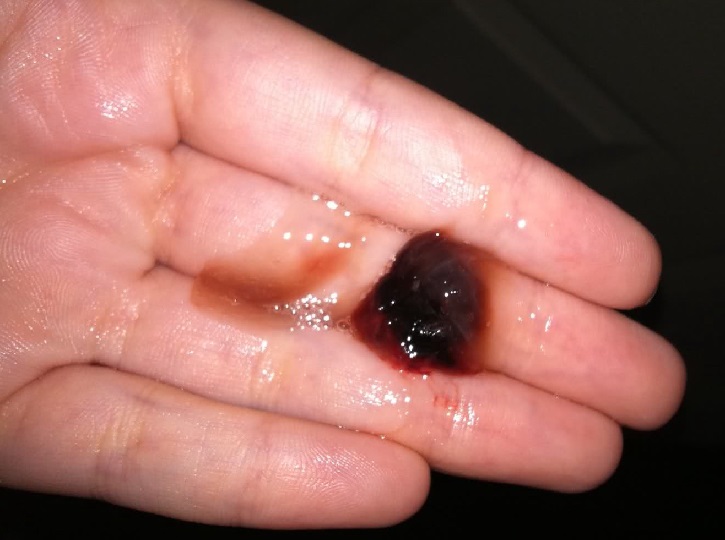Кровь в мокроте на руке