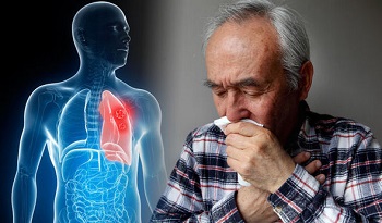 Першение в горле и рак легких