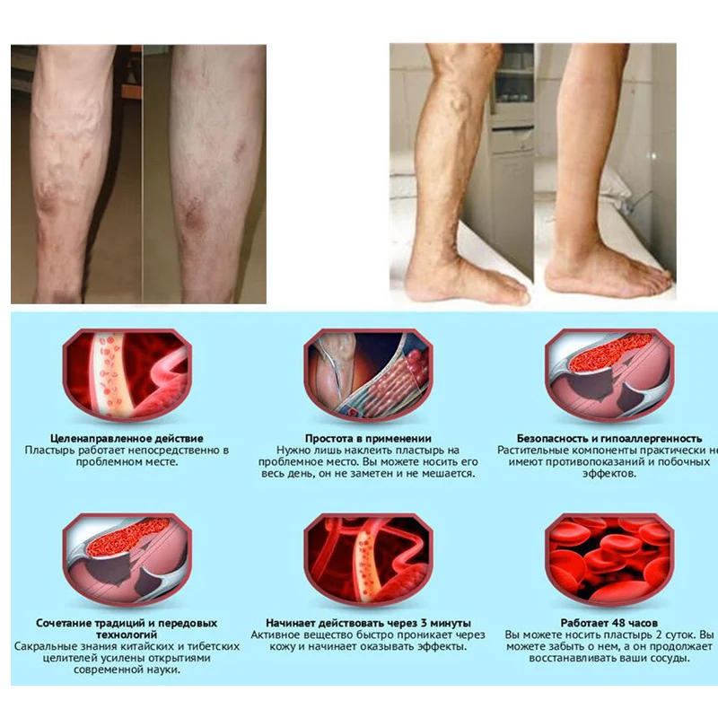 2PCS-Varicose-veins-treatment-leg-acid-bilges-itching-earthworm-lumps-old-bad-leg-vasculitis-cream-Free (3)