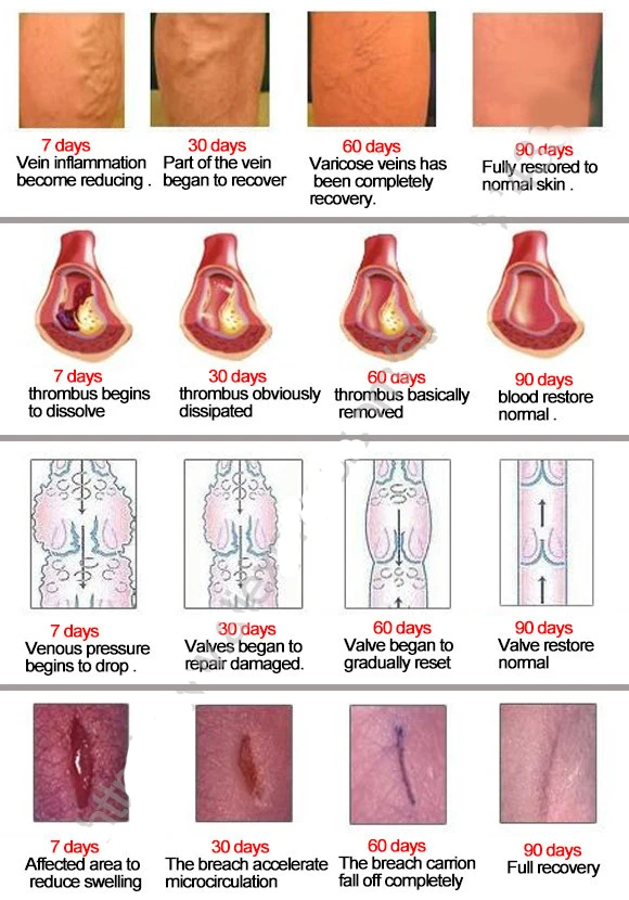 10pack-Varicosity-Medical-Varicose-Veins-Cream-Treatment-Anti-Foot-Leg-Vasculitis-Phlebitis-Herbal-Product-Medical-Plaster (6)