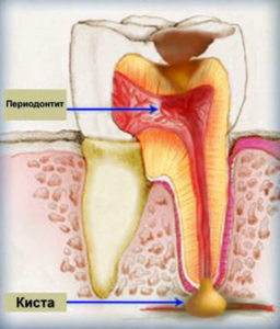 Одонтогенный гайморит опасное последствие кариеса зубов