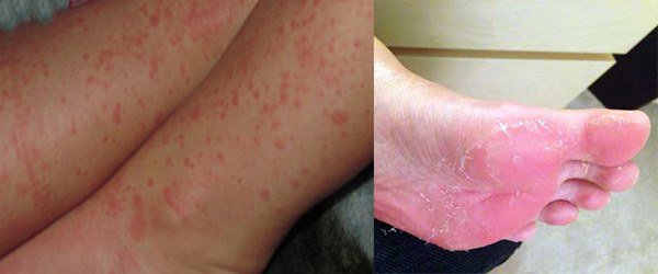 проявление аллергии на ногах