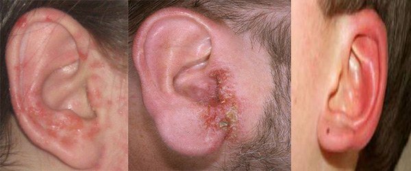 проявление аллергии на ушах