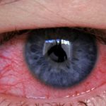 Аллергия на глазах: виды, симптомы и лечение