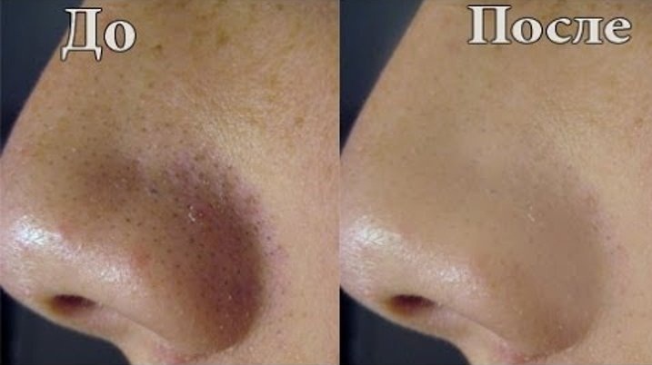 Чистка носа: до и после