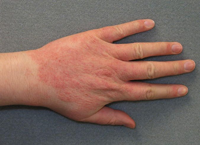 Аллергия на коже рук