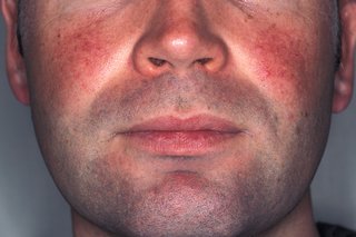 Picture of red patches on a man