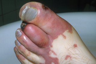 Picture of a foot affected by gangrene