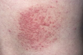 A rash composed of crops of small red raised spots.