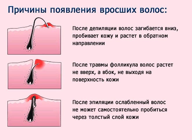 Виды расположения вросших волос схематично