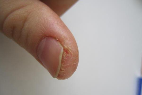 Трещины возле ногтей