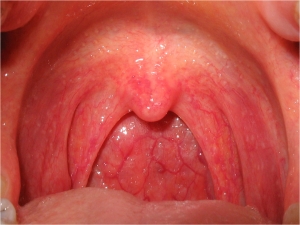 воспаление слизистой рта