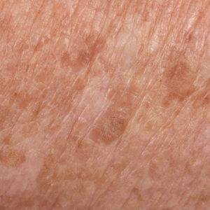 Age and Brown Spots, California Skin Skin Insititute