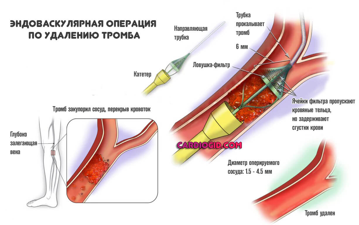 эндоваскулярное-удаление-тромба