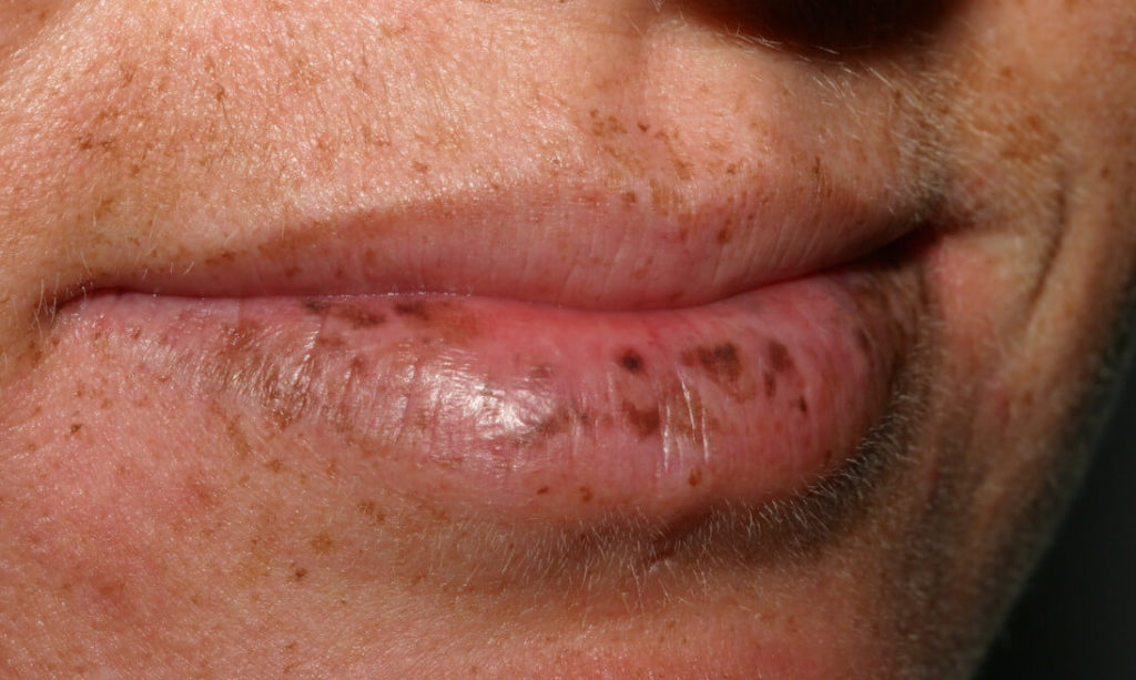 Чёрные и тёмные пятна на губах – фото, причины и как избавиться
