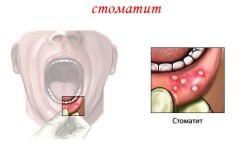 Проявление стоматита во рту