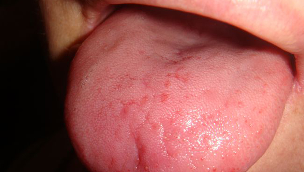 Аллергия на языке может вызывать болевые ощущения