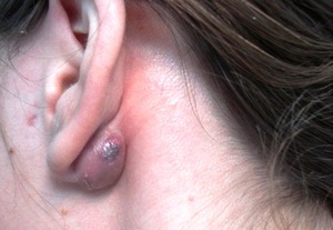Атерома на голове за ухом показана на фото.