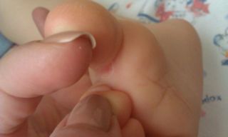 Облазит кожа между пальцами на ногах у ребенка