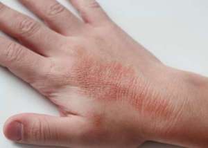 аллергия на руке