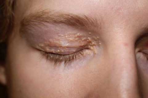 Кожные патологии при СД в области глаз
