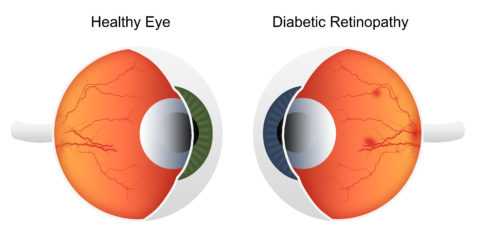Поражение артериол глазного дна