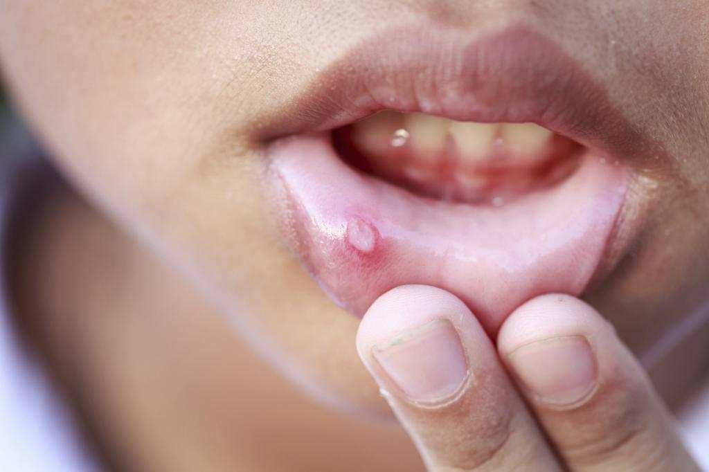 язва на внутренней стороне губы лечение