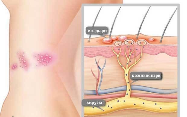 Опоясывающий герпес