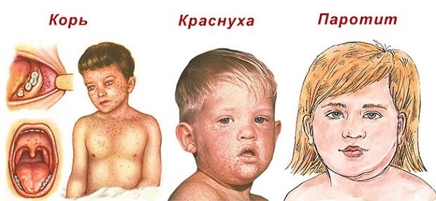 Детские инфекции