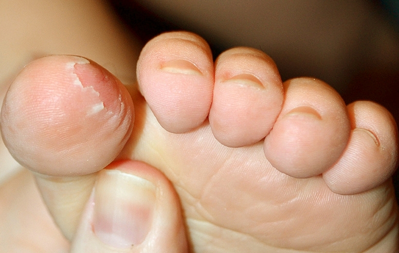 peeling-of-skin-on-feet