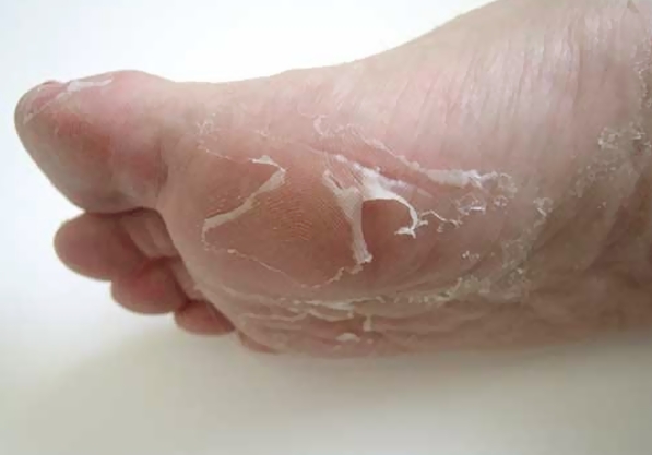 skin-peeling-off-from-eczema