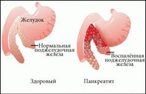 Воспалительный процесс поджелудочной железы