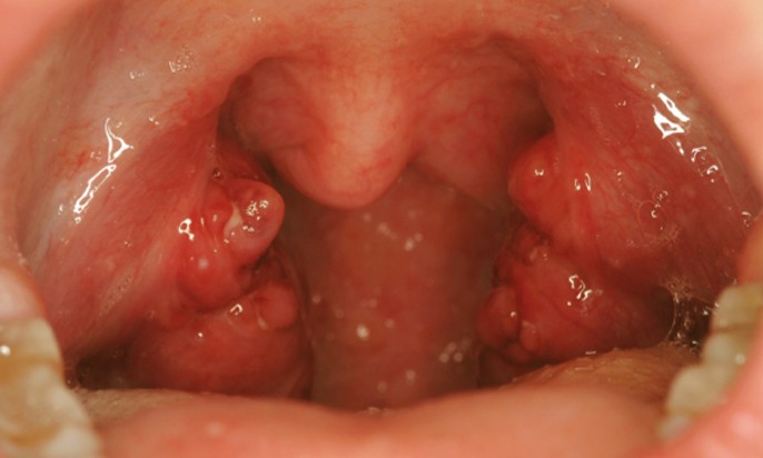 enlarged tonsils pictures