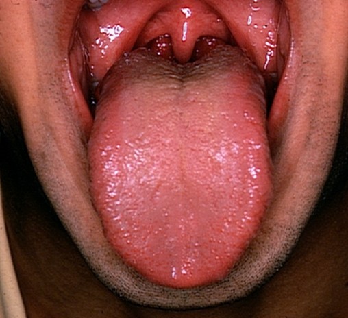 enlarged tonsils