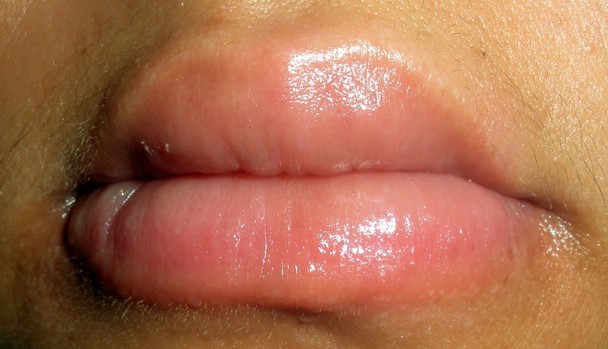 swollen lips pictures 2