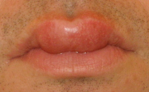 swollen lips pictures 3