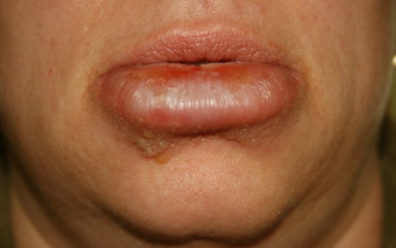 swollen lips pictures