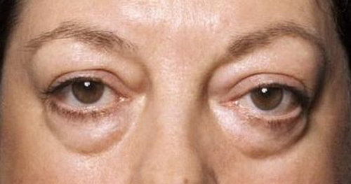 Swelling under the eye involving both left and right eye.picture