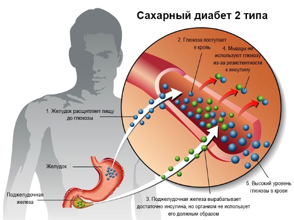 Симптомы сахарного диабета у женщин 1, 2 типа. Первые признаки при беременности, после 30, 40, 50 лет, норма сахара. Анализы и лечение