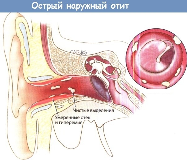 Лучшие антибиотики при отите у взрослого, ребенка. Таблетки, уколы, капли