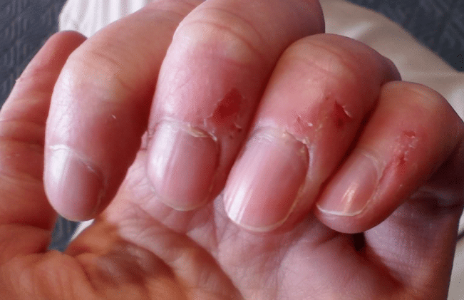 peeling around the nails