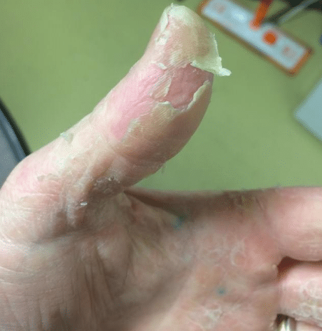 peeling fingertip