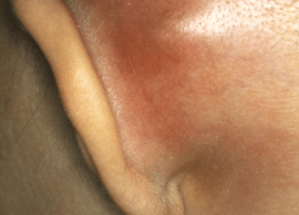 Causes of bumps behind ear