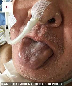 The man spent weeks in hospital and needed a tube surgically inserted into his neck to help him breathe, but his tongue eventually returned to normal (pictured)