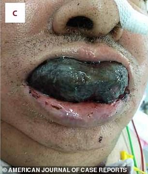 His condition got worse while he was in hospital as the bleeding inside his tongue increased and it swelled up to block his airway (pictured on day five at his worst)